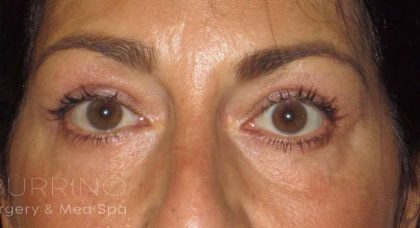 Eyelid Lift Before & After Patient #1714