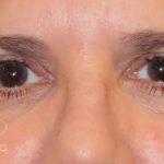 Eyelid Lift Before & After Patient #1717