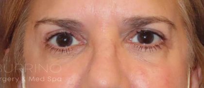 Eyelid Lift Before & After Patient #1717