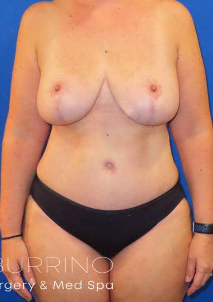 Mommy Makeover Before & After Patient #535