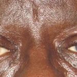 Eyelid Lift Before & After Patient #1720