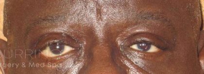 Eyelid Lift Before & After Patient #1720