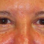 Eyelid Lift Before & After Patient #1723