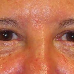 Eyelid Lift Before & After Patient #1723