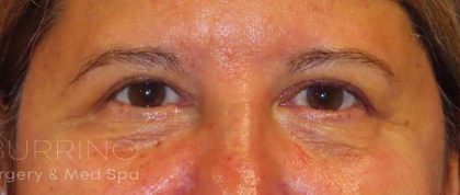Eyelid Lift Before & After Patient #1723