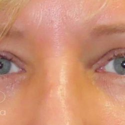 Eyelid Lift Before & After Patient #1726