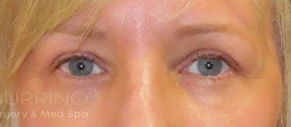 Eyelid Lift Before & After Patient #1726