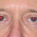 Eyelid Lift Before & After Patient #1729