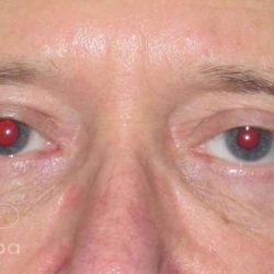 Eyelid Lift Before & After Patient #1729