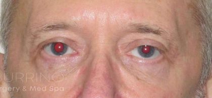 Eyelid Lift Before & After Patient #1729