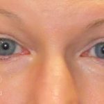 Eyelid Lift Before & After Patient #1732