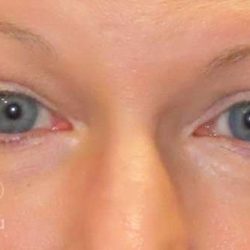 Eyelid Lift Before & After Patient #1732