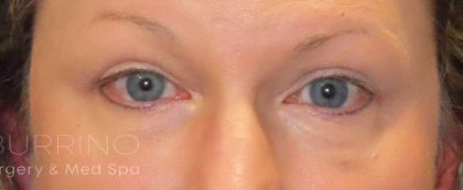 Eyelid Lift Before & After Patient #1732