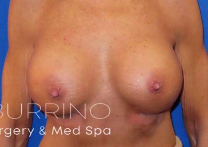 Breast Revision Before & After Patient #1760