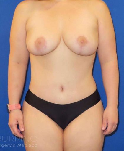 Breast Lift Before & After Patient #1869