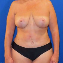 Breast Lift Before & After Patient #1915