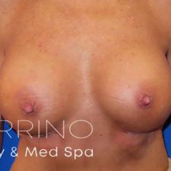Breast Augmentation Before & After Patient #2011