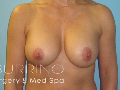 Breast Augmentation Before & After Patient #2033