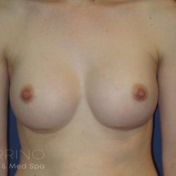Breast Augmentation Before & After Patient #2081
