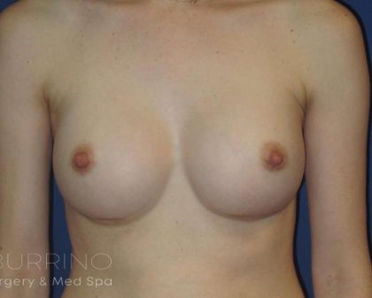 Breast Augmentation Before & After Patient #2081