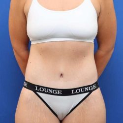 Lower Body Lift Before & After Patient #611