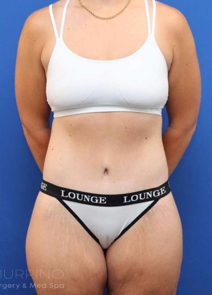 Lower Body Lift Before & After Patient #611