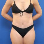 Liposuction Before & After Patient #652