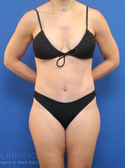 Liposuction Before & After Patient #652