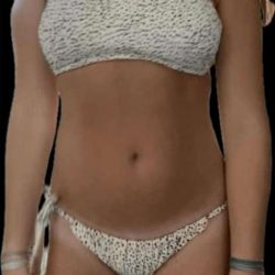 Liposuction Before & After Patient #655