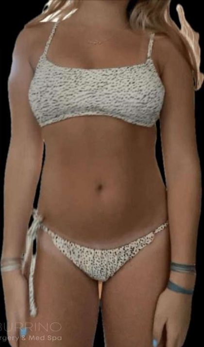 Liposuction Before & After Patient #655