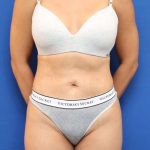 Liposuction Before & After Patient #668