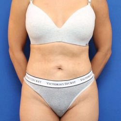 Liposuction Before & After Patient #668