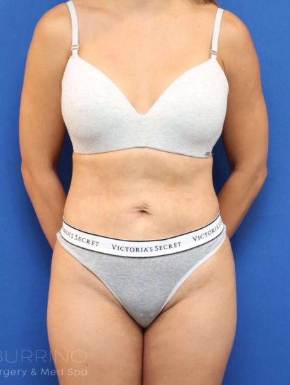 Liposuction Before & After Patient #668