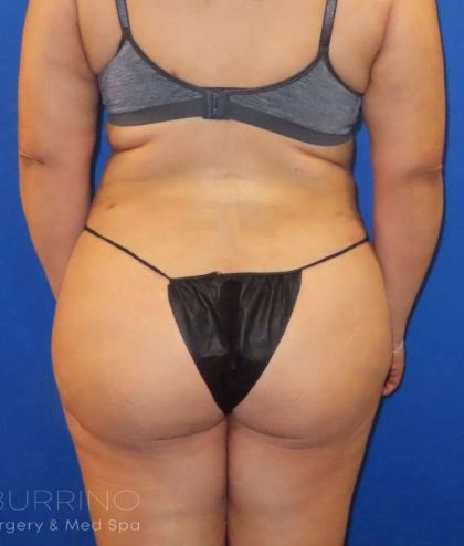 Liposuction Before & After Patient #684