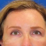 Restylane&reg; Before & After Patient #439