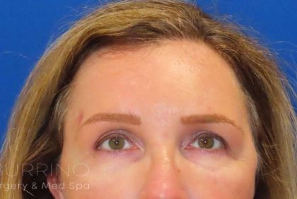 Restylane® Before & After Patient #439