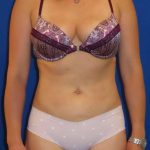 Liposuction Before & After Patient #749