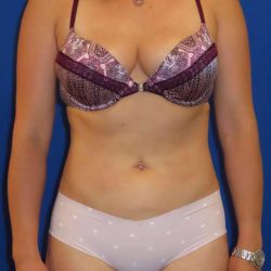 Liposuction Before & After Patient #749