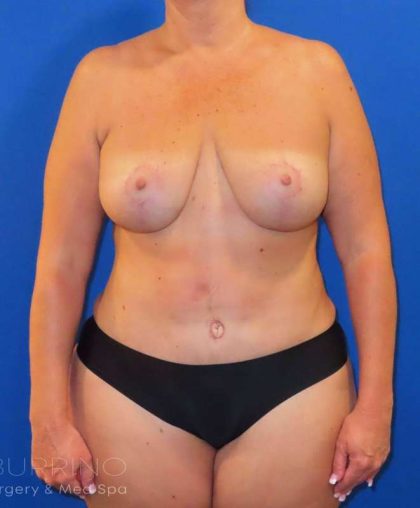 Liposuction Before & After Patient #777