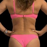 Liposuction Before & After Patient #793