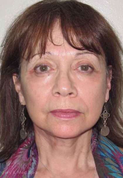 Laser Skin Resurfacing Before & After Patient #422
