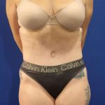 Liposuction Before & After Patient #852