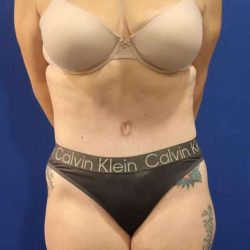 Liposuction Before & After Patient #852