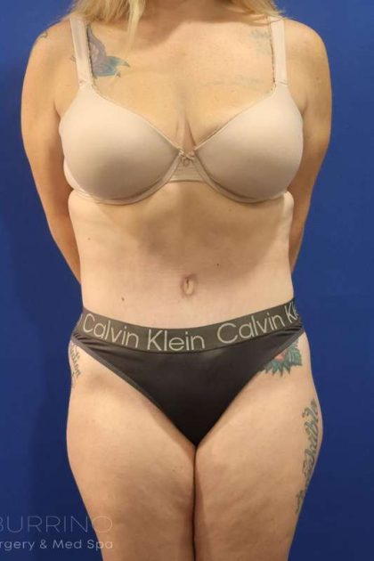 Liposuction Before & After Patient #852