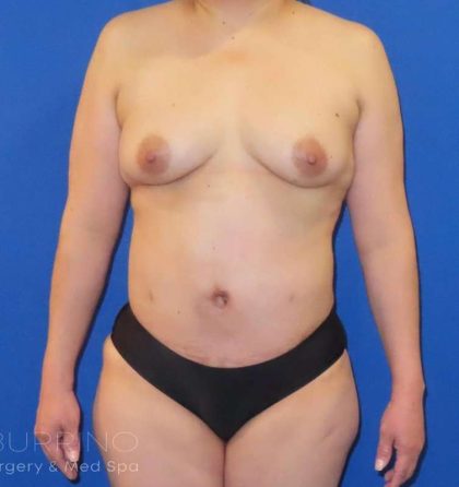 Fat Transfer Before & After Patient #891