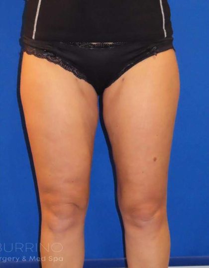 Smartlipo® Before & After Patient #445