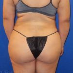 Brazilian Butt Lift Before & After Patient #912