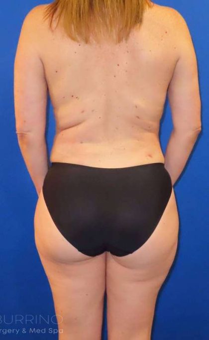 Brazilian Butt Lift Before & After Patient #923