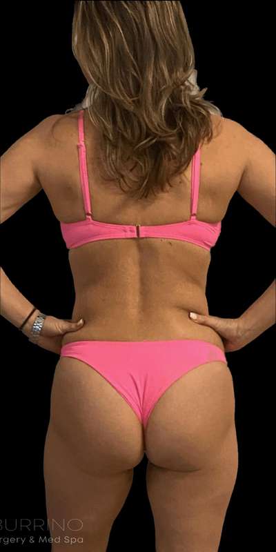 Brazilian Butt Lift Before & After Patient #926