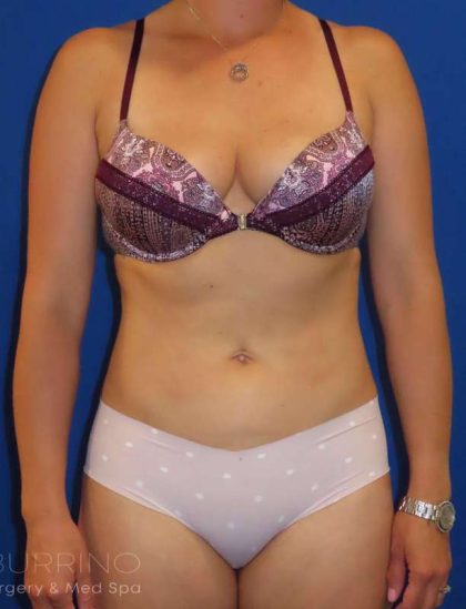 Smartlipo® Before & After Patient #452